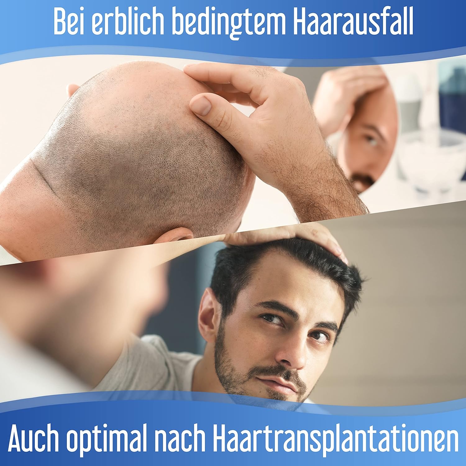 Hairforte PROCAPIL DHT Blocker Spray for Hereditary Anti-Hair Loss Treatment