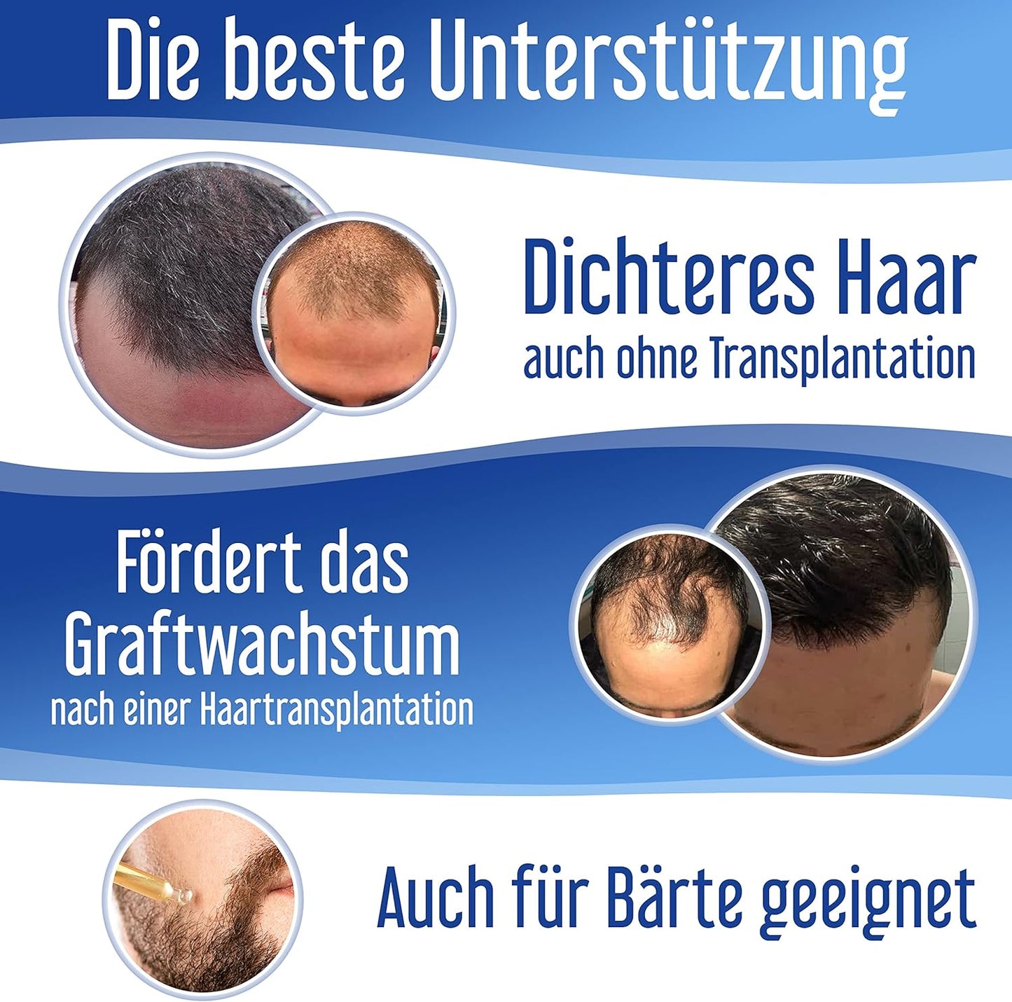 Hairforte PROCAPIL DHT Blocker Spray for Hereditary Anti-Hair Loss Treatment