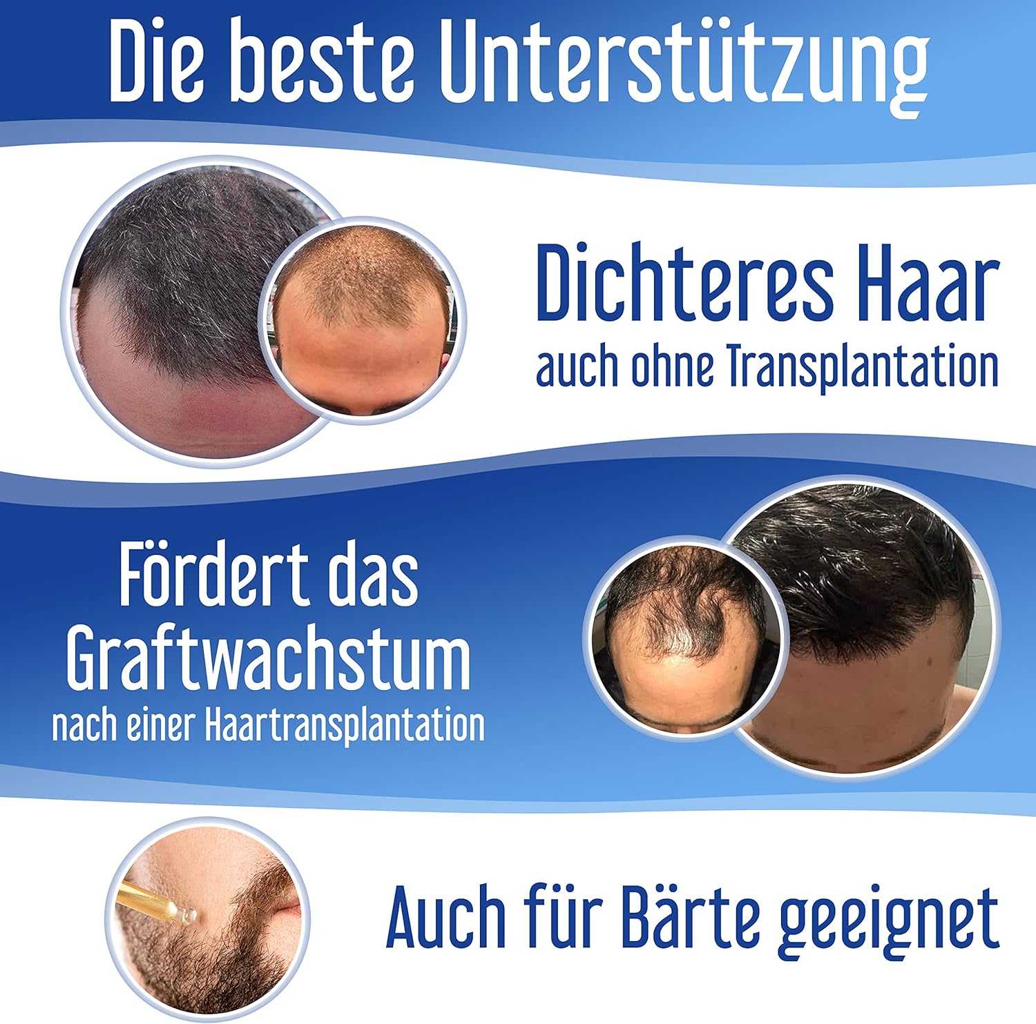 Hairforte PROCAPIL DHT Blocker Spray for Hereditary Anti-Hair Loss Treatment