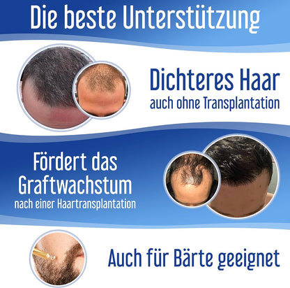 Hairforte PROCAPIL DHT Blocker Spray for Hereditary Anti-Hair Loss Treatment